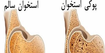 پوکی استخوان، بیماری خاموش