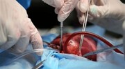 بیمارستان امام رضا(ع) مشهد رتبه سوم پیوند قلب را در کشور کسب کرد