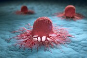 درمان‌های نوآورانه چگونه تومور سرطانی را از بین می‌برد