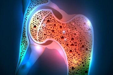 پوکی استخوان شایع ترین بیماری متابولیک است